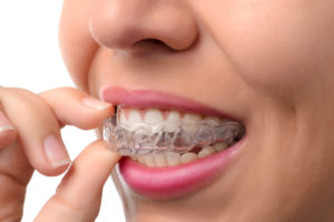 invisalign-picture